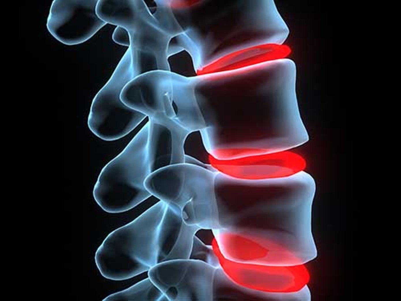 Triangle Spinal Decompression