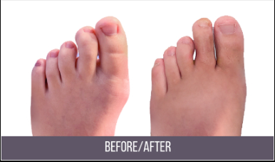 Achilles Tendonitis Treatment Center