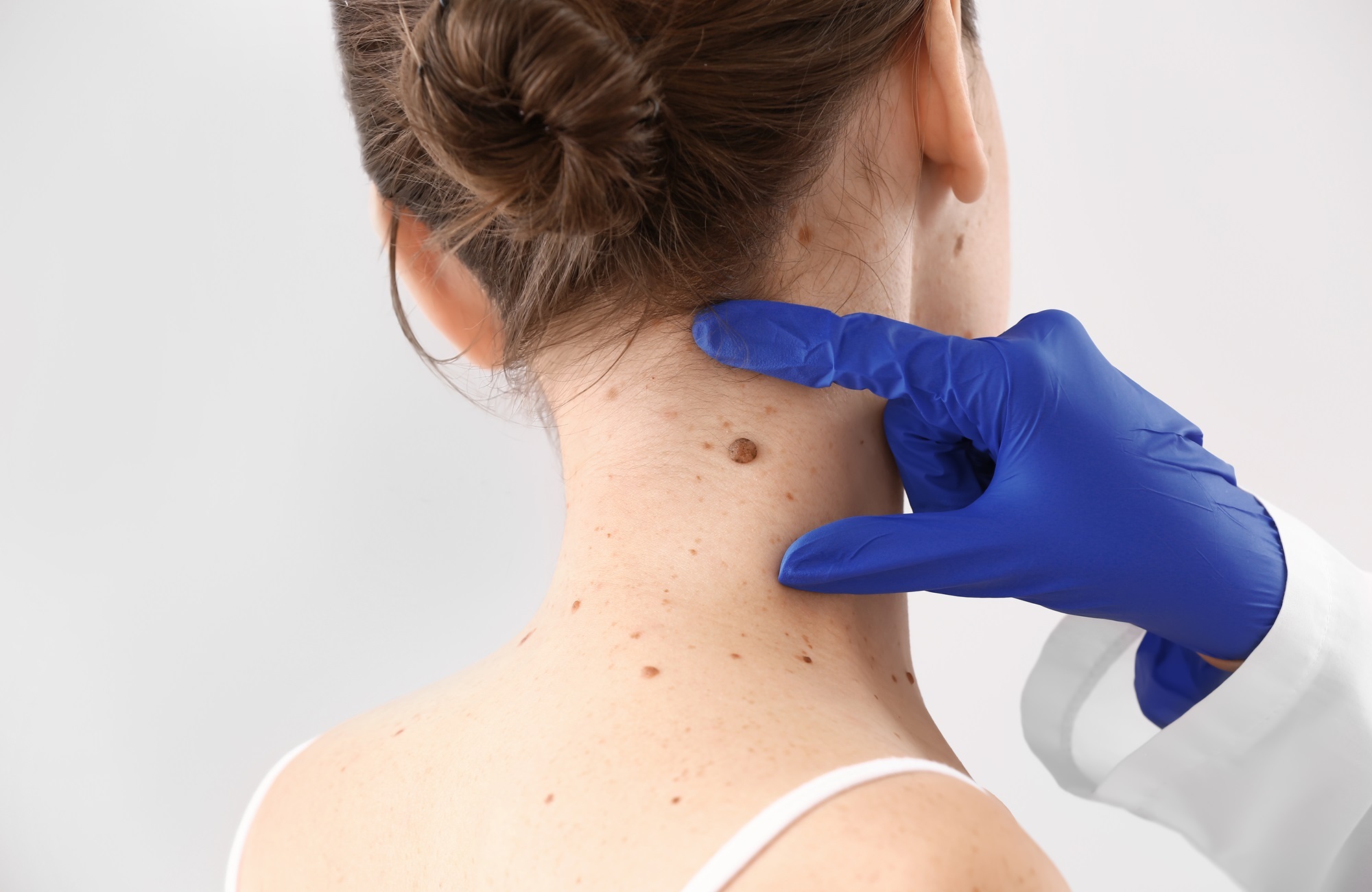 Mole Removal San Diego