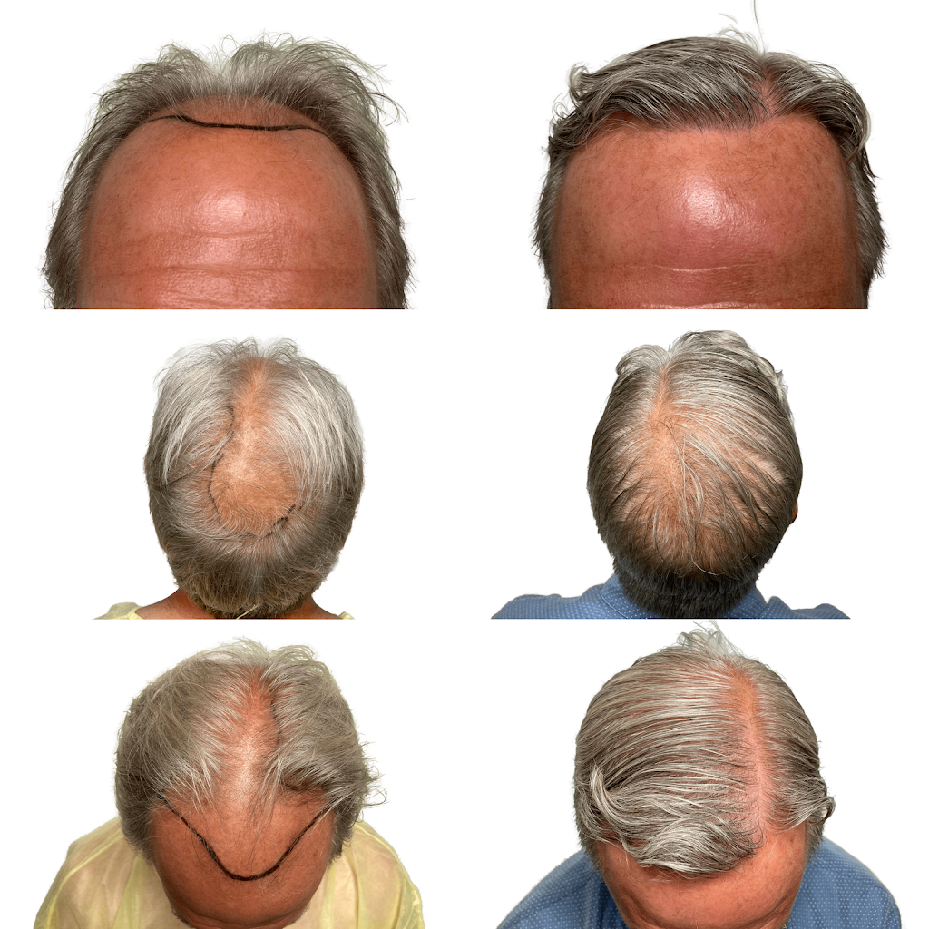 Maxim Hair Restoration & Transplants - New York City
